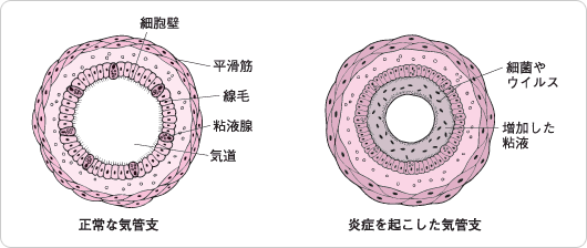 気管支炎の起こるしくみ